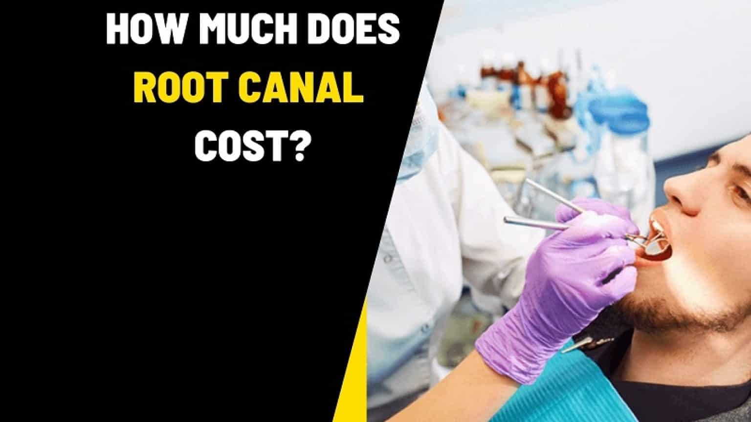 Root Canal Price In Florida