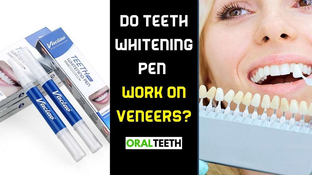 Do teeth whitening pen work on veneers