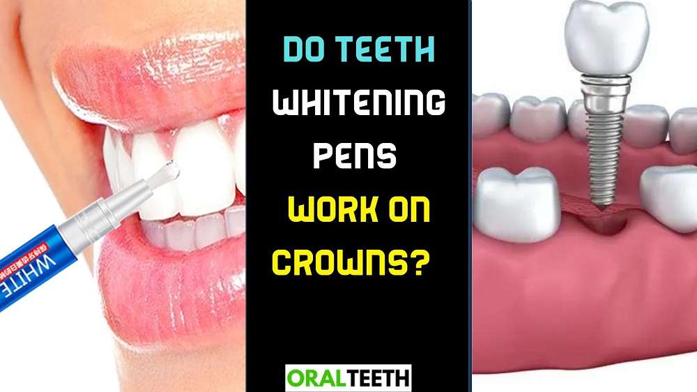Do teeth whitening pens work on crowns