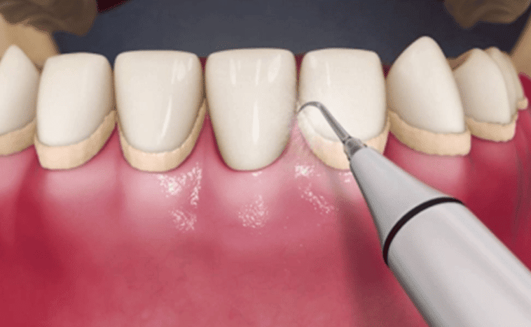 How Does Ultrasonic Teeth Cleaning Work?