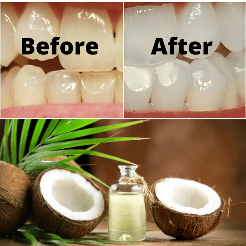 How Coconut Oil Teeth Whitening Works?